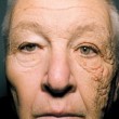 トラック運転手を２８年した人がサイドガラスより直射日光を浴び続け、顔の左半分が老化促進している